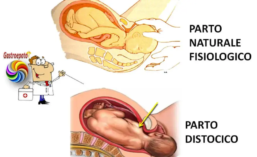 Parto distocico - cause, interventi e recupero