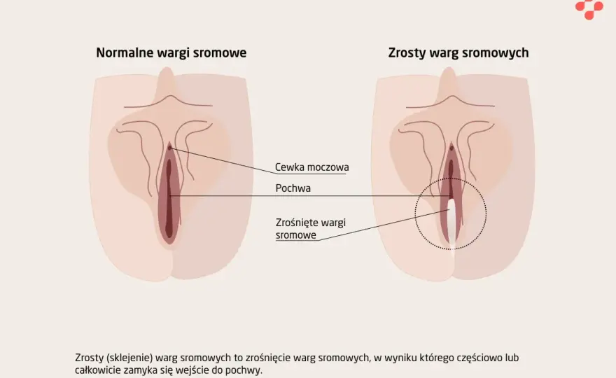 Jak wygląda srom? Prawda o anatomii i zdrowiu intymnym