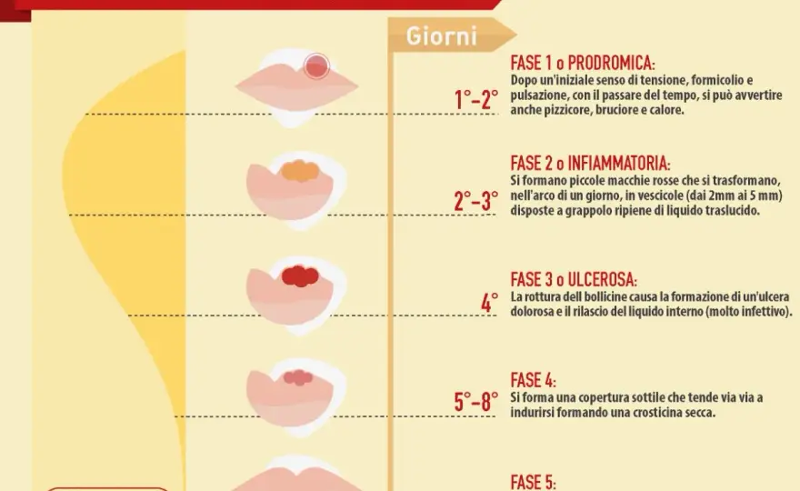 Herpes labiale frequente, perché torna e cosa fare?