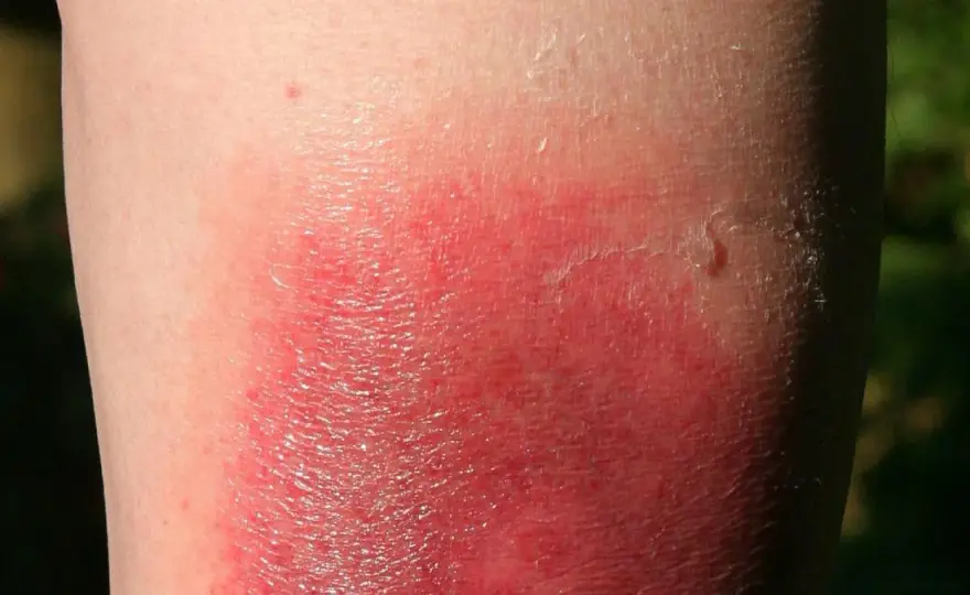 Symptome Borreliose beim Menschen: Warnzeichen, die Sie kennen sollten