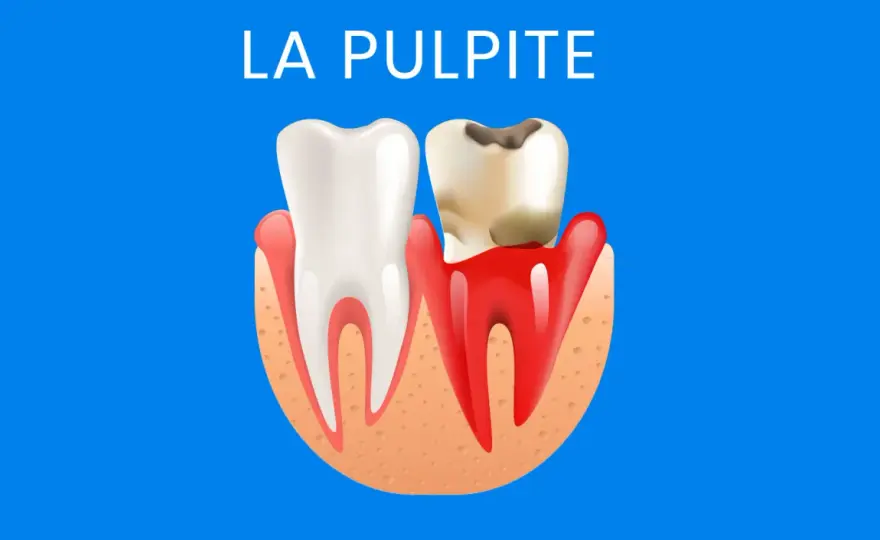 Pulpite - Dolore al dente? Cause, rimedi e quando andare dal dentista