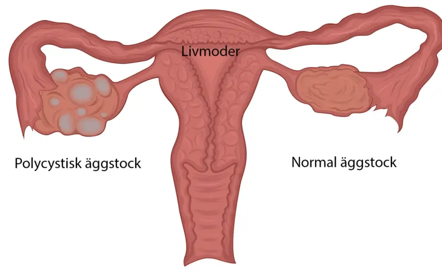 PCOS-symtom - så känner du igen dem och när du ska söka vård