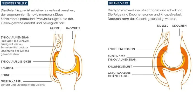 Die entscheidende Rolle der Diagnostik bei rheumatischer Arthritis
