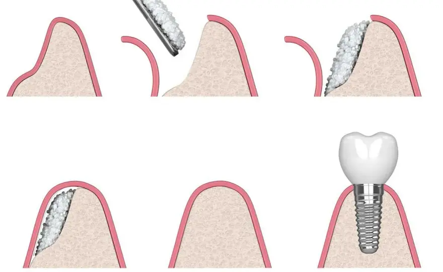 Innesto osseo dentale - Guida completa a costi, tempi e tecniche