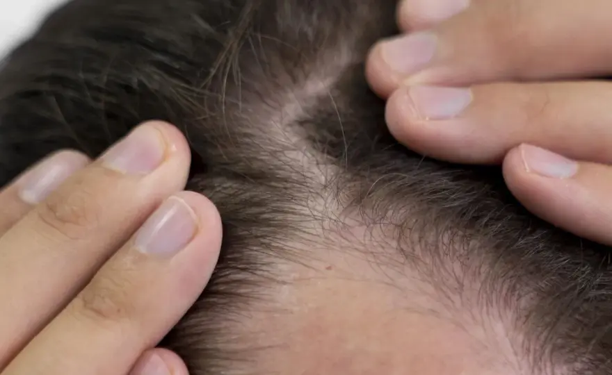 Ciclo capilar y caída del pelo, lo que es normal y cuándo preocuparse