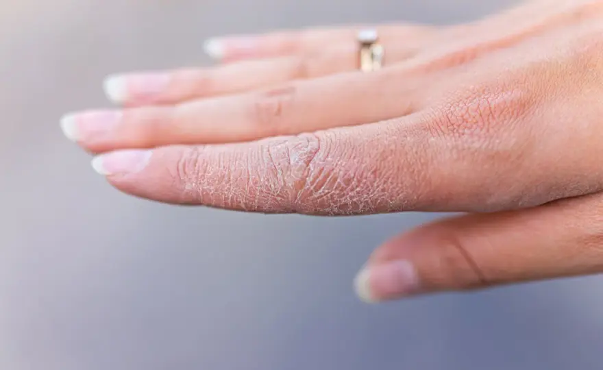 Sprickor i fingertopparna - Få lindring & förebygg nya!