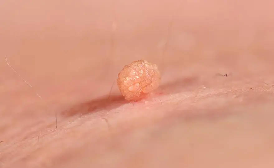 HPV objawy - kłykciny kończyste. Czy to na pewno HPV?
