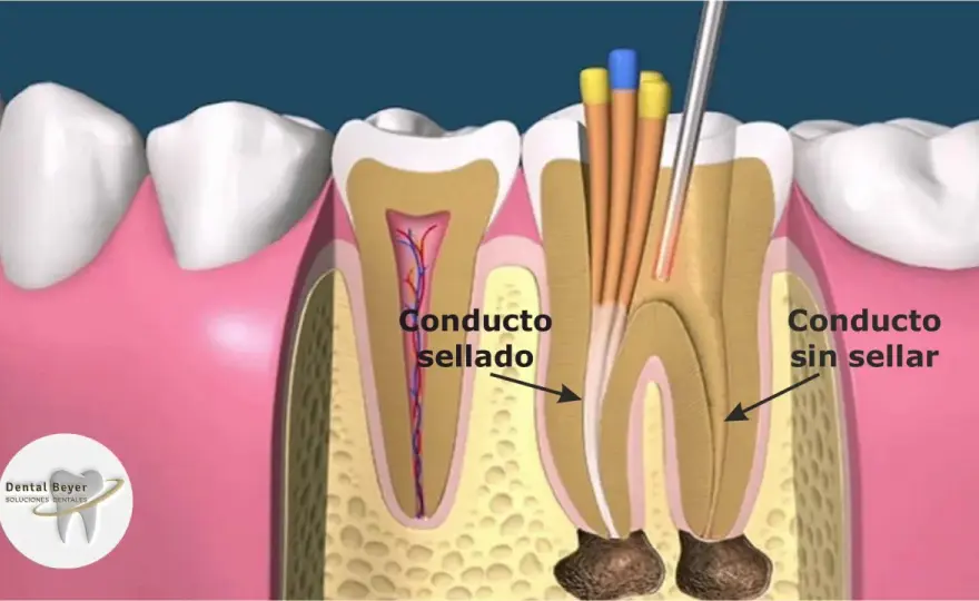 Reendodoncia - cuándo repetirla y cómo conservar el diente