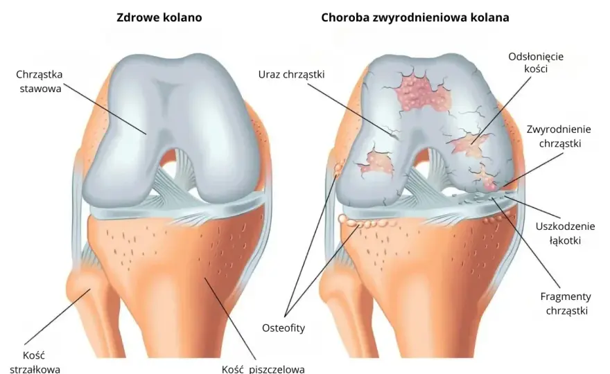 Gonartroza - jak rozpoznać zwyrodnienie kolana i co naprawdę pomaga?
