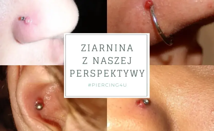 Infekcja kolczyka w pępku: Jak rozpoznać objawy i skutecznie leczyć?