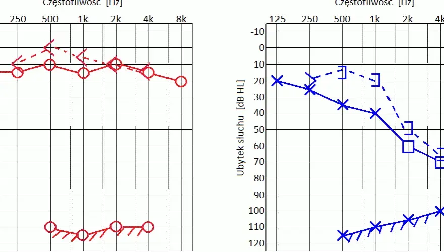 Audiogram - jak wygląda badanie słuchu i ile faktycznie trwa u specjalisty