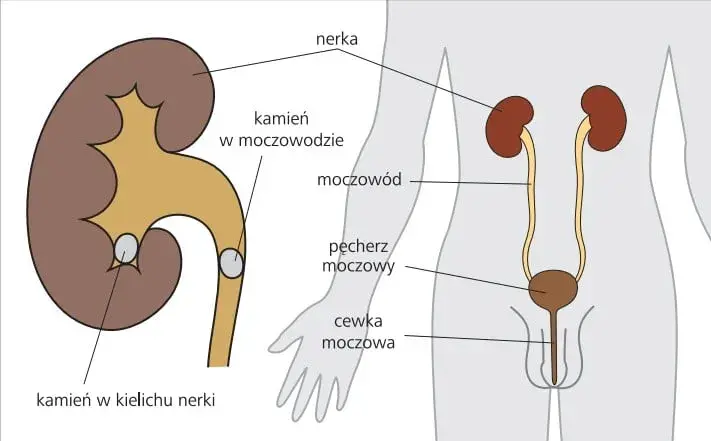 Jakie są przyczyny kamicy nerkowej? Poznaj czynniki ryzyka i zapobieganie