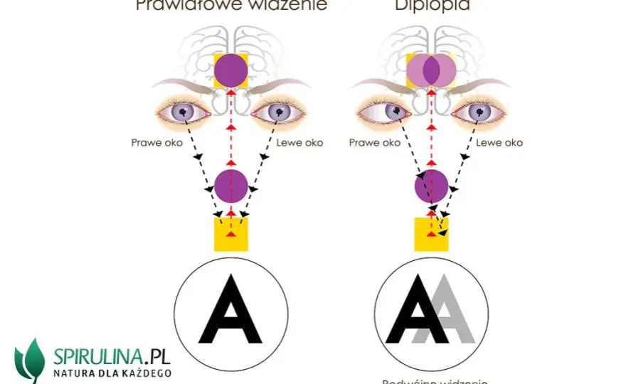 Podwójne widzenie przyczyny neurologiczne: co może je powodować?
