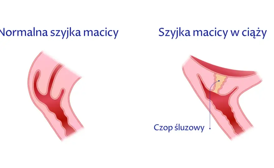Jak skutecznie zapobiec skracaniu szyjki macicy w ciąży i uniknąć zagrożeń
