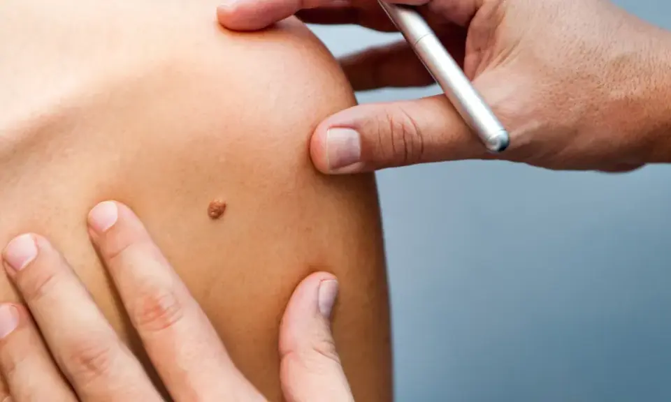 Examen d'un grain de beauté sur l'épaule, un médecin utilise un stylo pour le marquer.