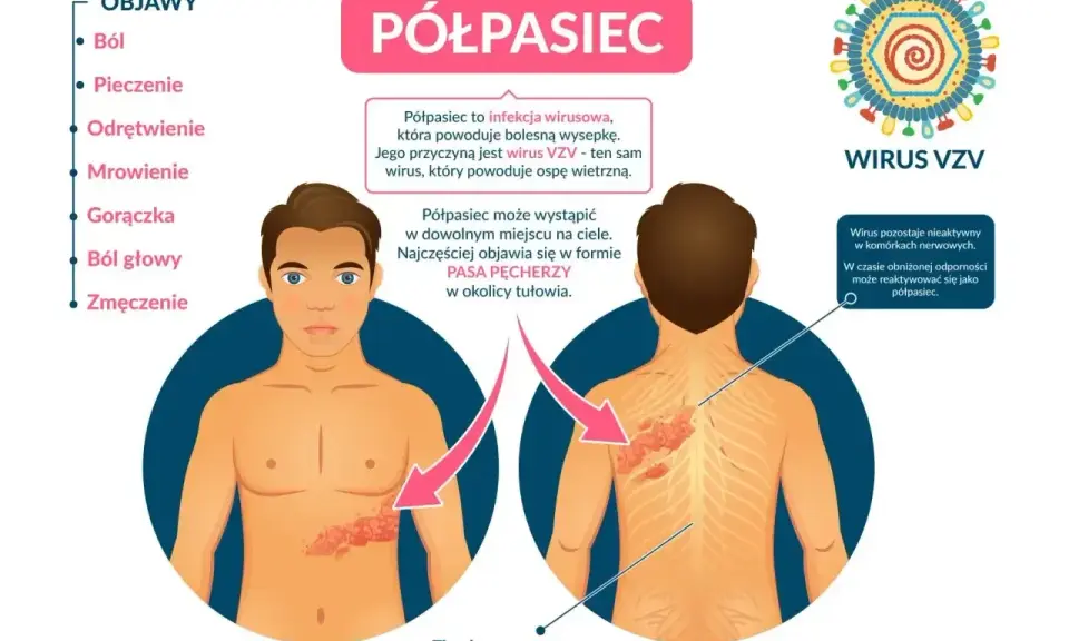 Objawy półpaśca: ból, pieczenie, odrętwienie, mrowienie, gorączka, ból głowy, zmęczenie. Jak złagodzić ból przy półpaścu? Półpasiec to wirus VZV.