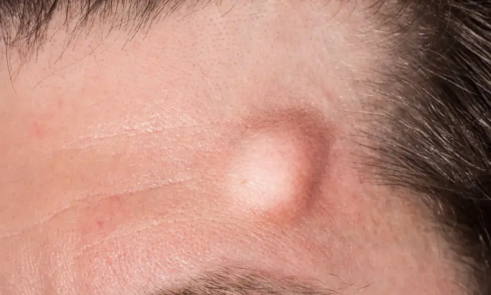 Gros plan sur un front humain, montrant un bouton sous cutané proéminent, légèrement rouge, près de la ligne des cheveux.