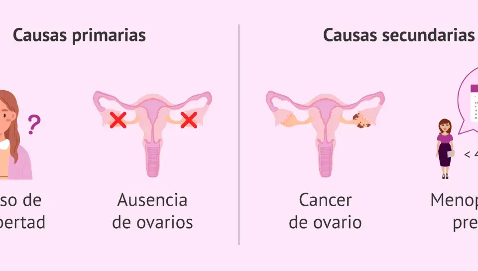 ¿Qué pasa si no te baja la regla en un mes? Causas primarias: retraso pubertad, ausencia ovarios. Causas secundarias: cáncer ovario, menopausia precoz.
