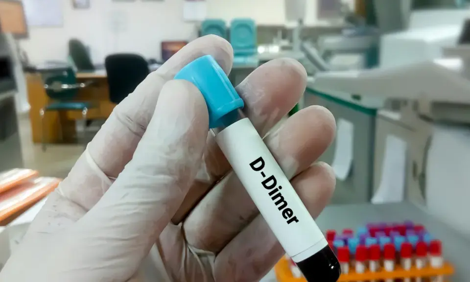 Rękawiczka trzyma probówkę z napisem "D-Dimer". W tle laboratorium, gdzie można dowiedzieć się, d-dimery jak obniżyć.