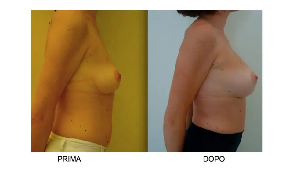 Confronto seno rifatto prima e dopo: immagine mostra il profilo di una donna, prima e dopo un intervento di mastoplastica additiva, evidenziando il cambiamento.