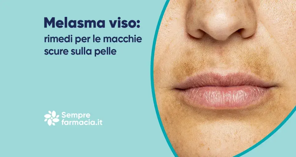 Primo piano del viso con melasma, evidenziando la zona baffetti scura e macchie sulla pelle. Rimedi per il melasma.