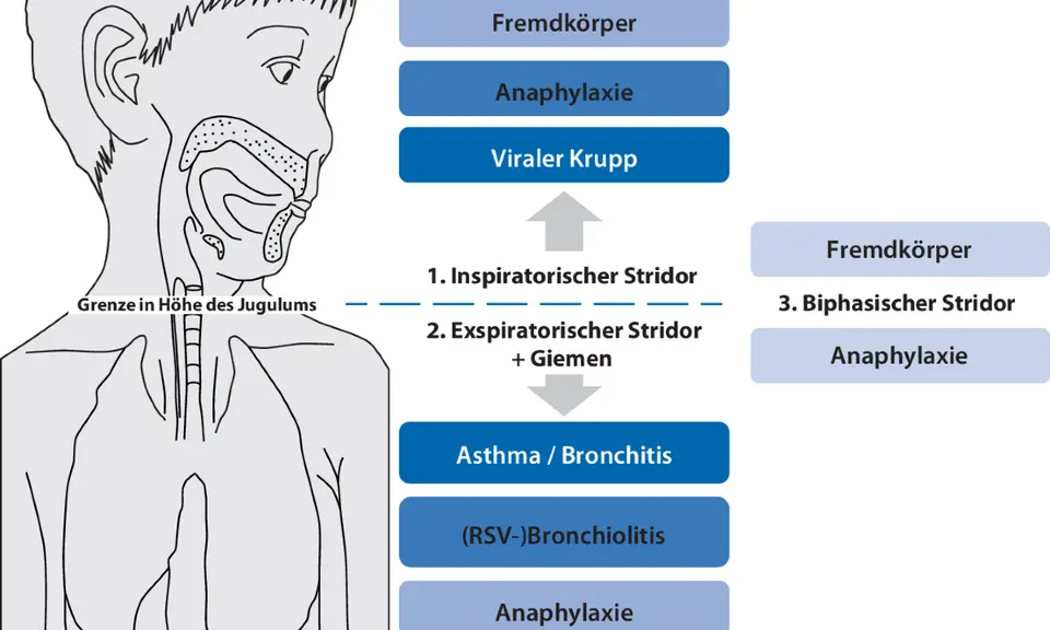 Schema zeigt Ursachen für Atemnot: Epiglottitis, Fremdkörper, Anaphylaxie, Krupp. Warum kriege ich schlecht Luft? Hier sind mögliche Gründe.