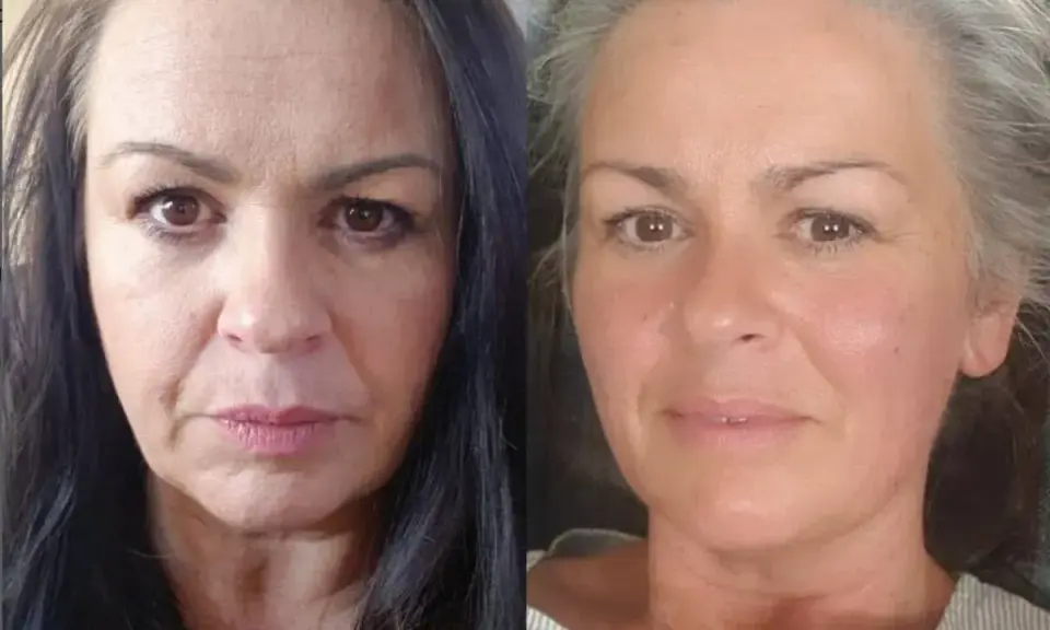 Avant/Après : une femme avant et après avoir pris du collagène. Sa peau semble plus lisse et radieuse.