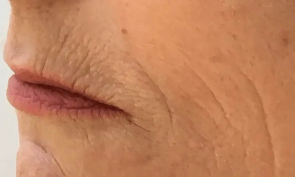 Nahaufnahme der Lippen und der Haut einer älteren Person mit tiefen Falten, die auf die Auswirkungen des Rauchens hinweisen. Kleine Pickel sind sichtbar.