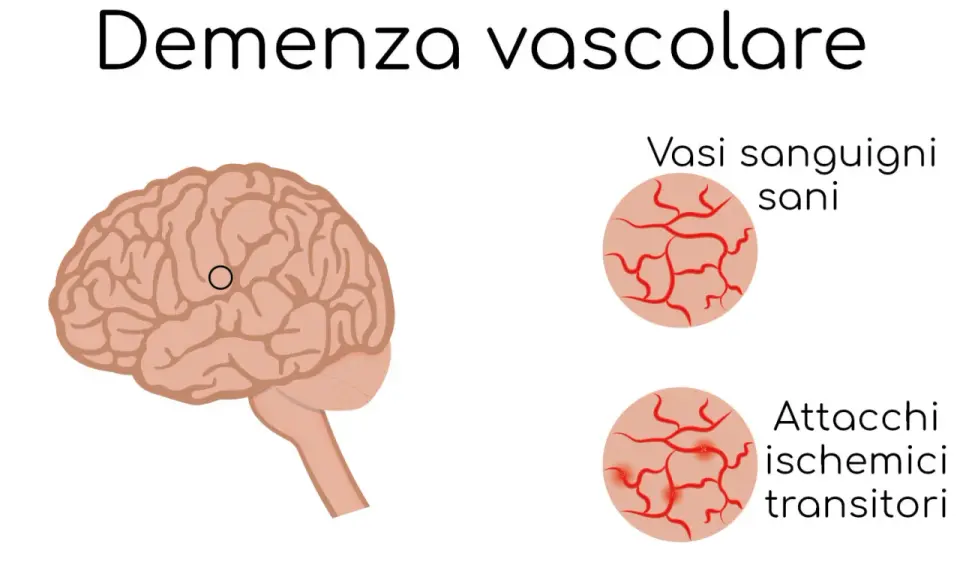 Illustrazione del cervello con un cerchio che indica un'area interessata da vasculopatia cerebrale cronica nell'anziano. Confronto tra vasi sanguigni sani e quelli colpiti da attacchi ischemici transitori.