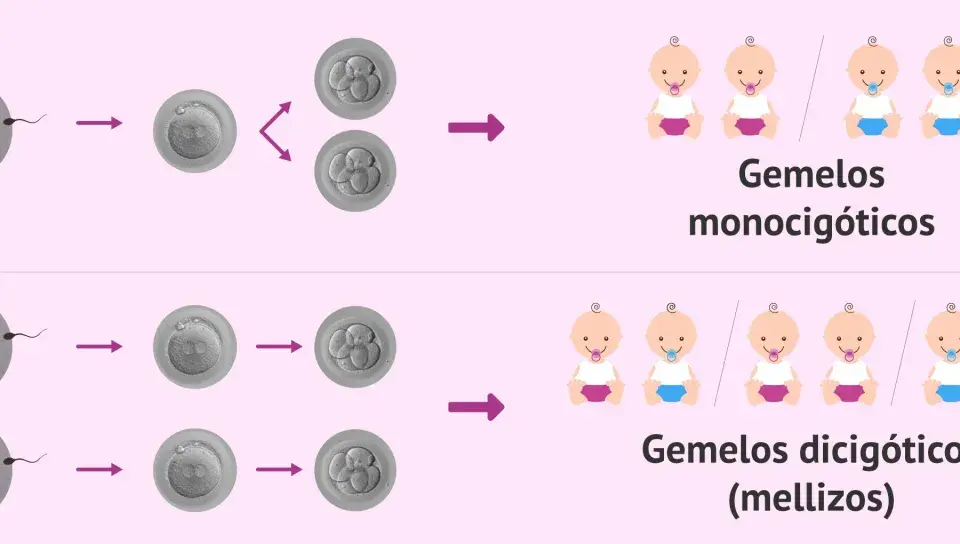 Ilustración de la concepción de gemelos. Los gemelos monocigóticos provienen de un óvulo y un espermatozoide, y pueden ser niño y niña. Los dicigóticos, de dos óvulos y dos espermatozoides.