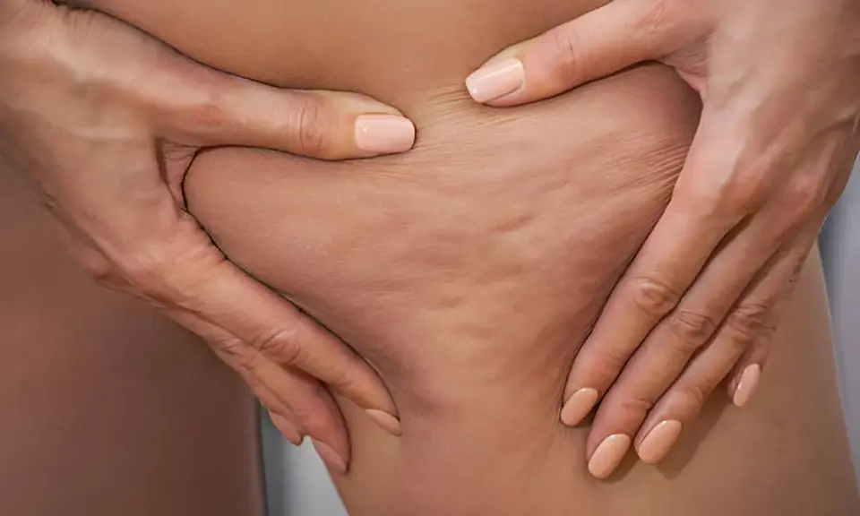 Manos pellizcando piel con celulitis edematosa, mostrando la textura irregular y abultada.