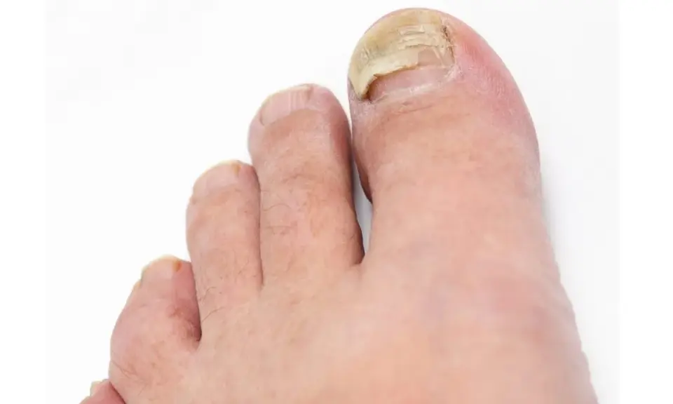 Gros plan sur un ongle d'orteil atteint d'un décollement ongle choc, jauni et épaissi.