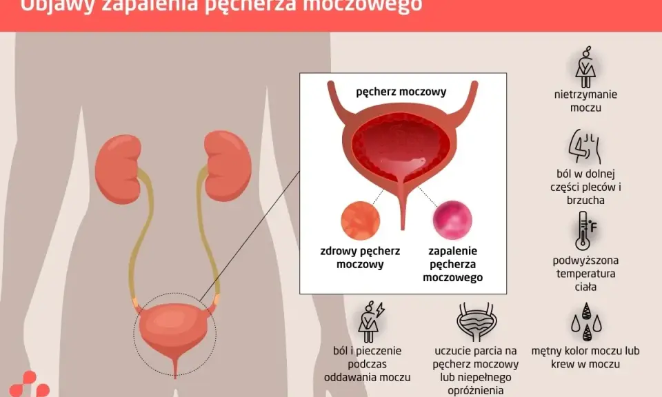 Ilustracja przedstawia objawy zapalenia pęcherza moczowego: ból, pieczenie, nietrzymanie moczu, gorączkę, ból pleców i brzucha, mętny mocz.
