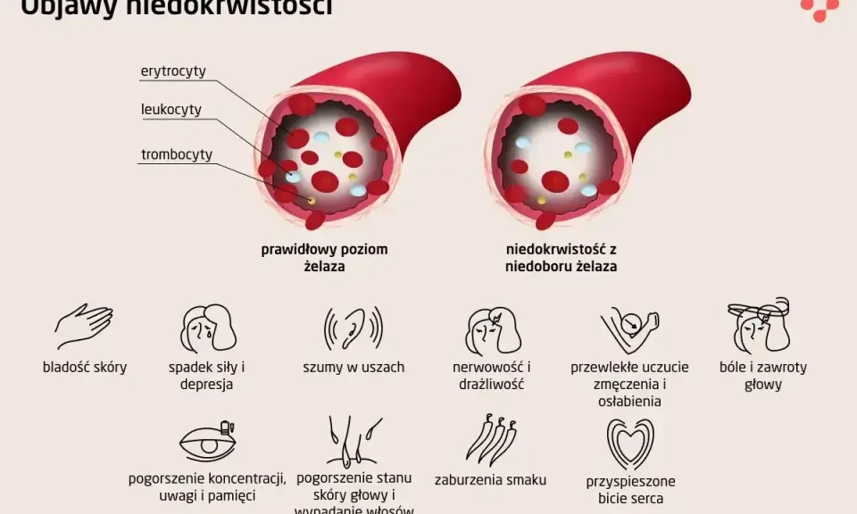 Porównanie poziomu żelaza: prawidłowy vs. niedobór. Niedobór żelaza objawia się m.in. bladością skóry, zmęczeniem, bólami głowy.