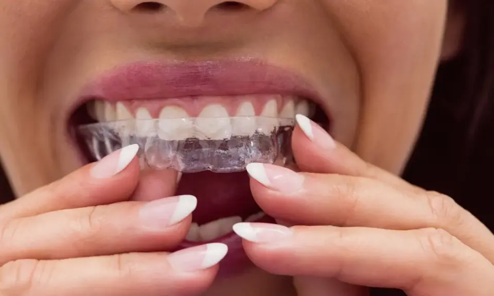 Kobieta zakłada przezroczystą szynę relaksacyjną na zęby.