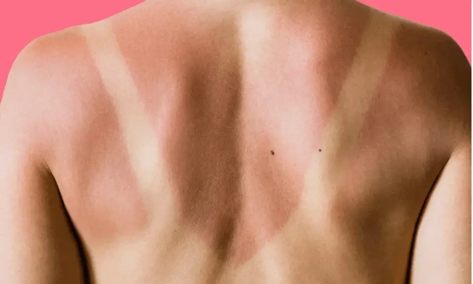 Schiena con evidente abbronzatura a strisce, segno di una giornata al sole con indumenti che hanno lasciato la pelle scoperta in alcune zone.