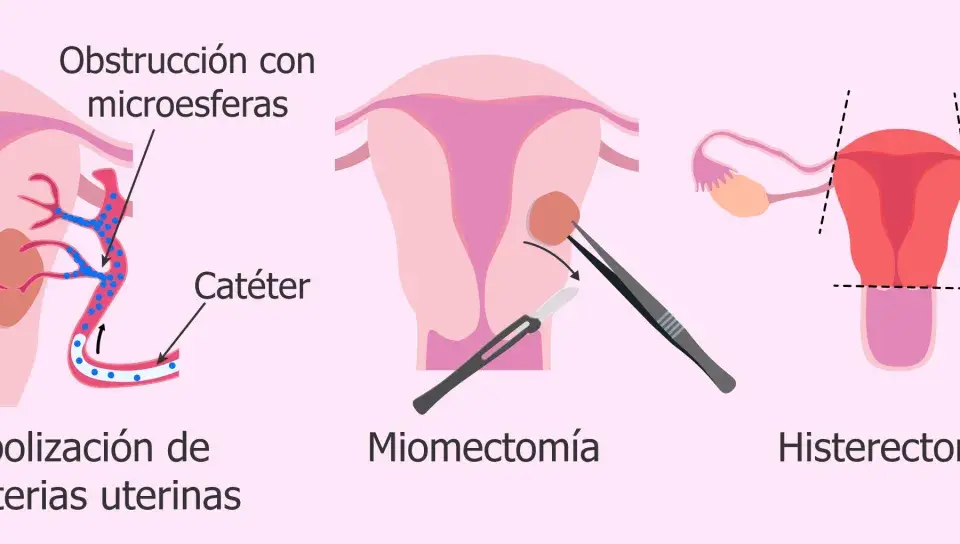 Ilustración de tratamientos para el mioma uterino: embolización, miomectomía y<bos> Histerectomía.