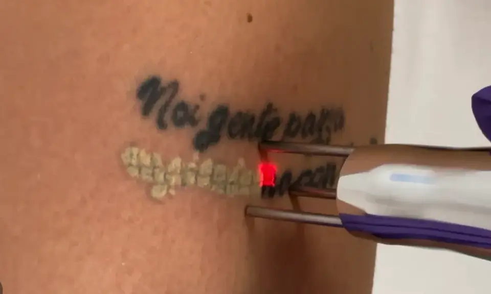 Rimozione tatuaggio con laser: un fascio rosso illumina la pelle mentre si procede a togliere il disegno.