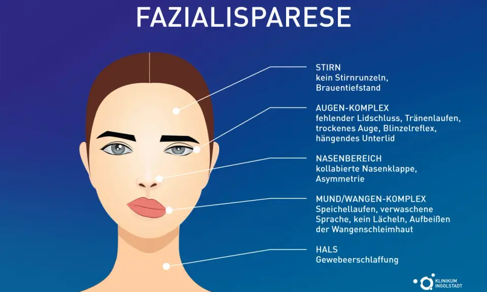 Illustration zeigt Fazialisparese-Symptome: Stirnfalten fehlen, Auge schließt nicht, Mundwinkel hängt, was zu einem Gefühl von Kribbeln im Gesicht führen kann.