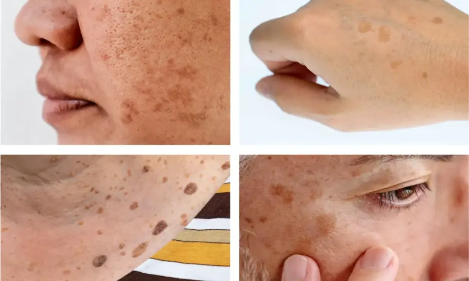 Gros plan sur des taches brunes sur la peau, dont un lentigo solaire sur le visage et le dos de la main.