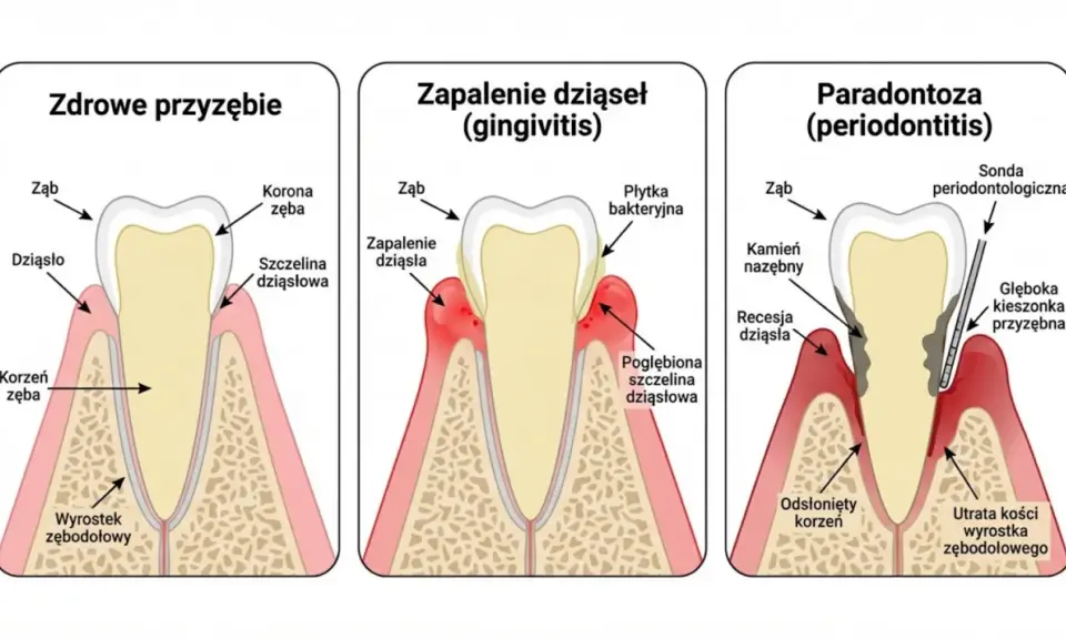 Ilustracja pokazuje postęp paradontozy: zdrowe dziąsła, zapalenie dziąseł i zaawansowaną paradontozę. Poznaj 3 skuteczne sposoby na paradontozę.