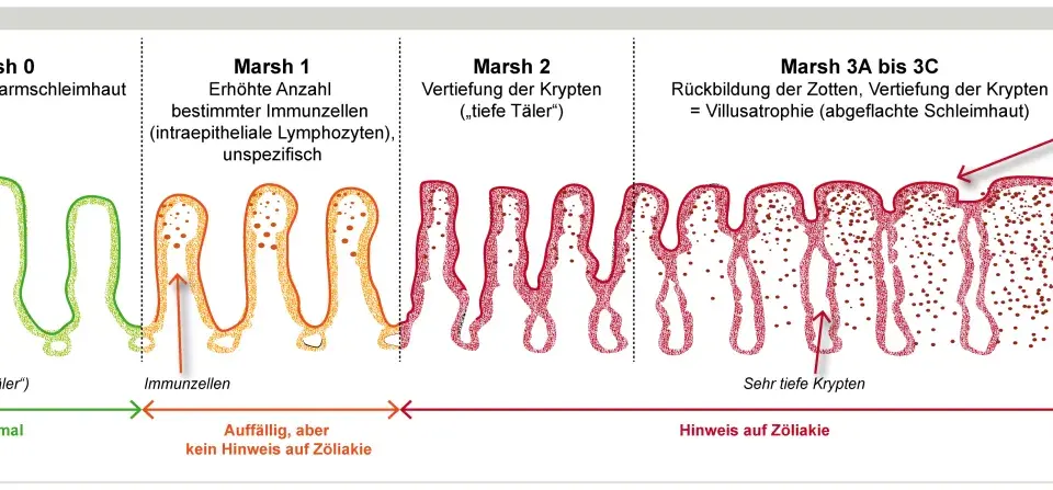 Darstellung der Marsh-Klassifikation von Zöliakie: Von gesunder Schleimhaut (Marsh 0) über Entzündung (Marsh 1-2) bis zur Zottenatrophie (Marsh 3), die bei einer **Haferallergie** auftreten kann.