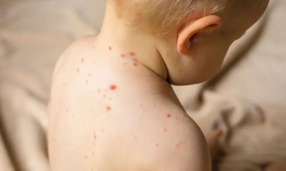 Enfant atteint de varicelle, avec des boutons rouges sur le dos et le cou. Conseils pour aider à comment faire sécher les boutons de varicelle rapidement.