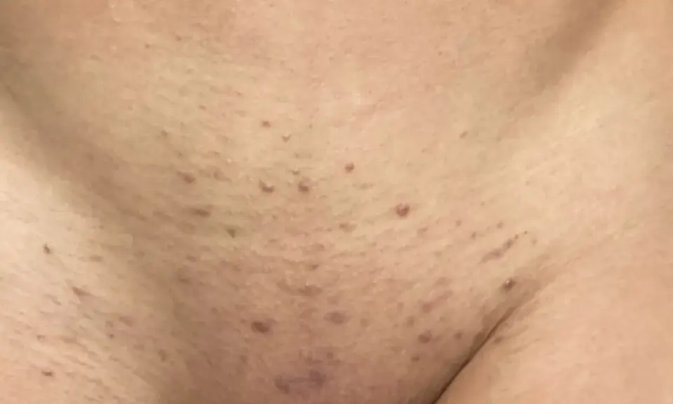 Peau présentant des boutons après rasage, avec des rougeurs et de petites imperfections.