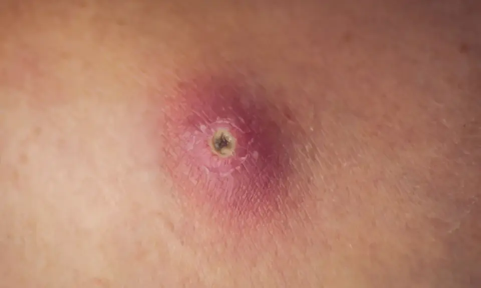 Gros plan d'un furoncle sur la cuisse, rouge et enflammé, avec un centre sombre.