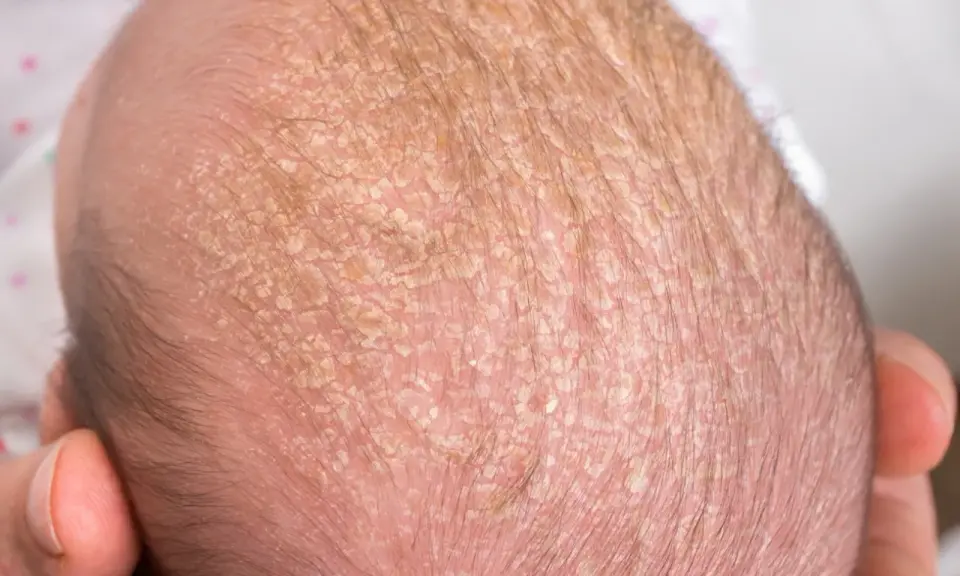 Testa di neonato con crosta lattea, squame giallastre e sottili capelli scuri.