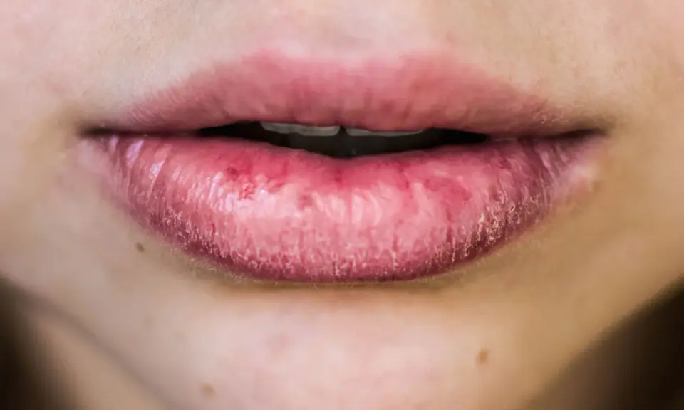 Labbra secche e screpolate, con segni di irritazione. Le cause possono essere molteplici, dal freddo alla disidratazione.