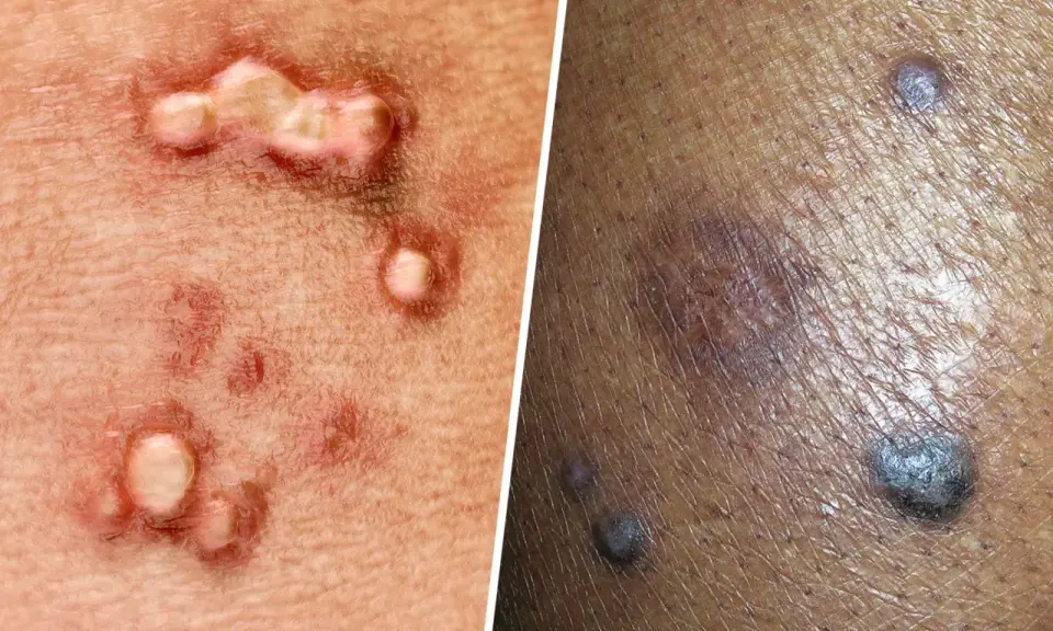 Primer plano de verrugas negras genitales y otras lesiones cutáneas.
