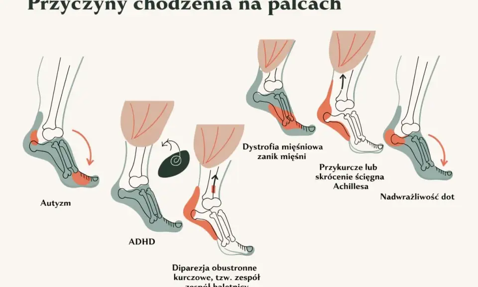 Ilustracja pokazuje, dlaczego dziecko chodzi na palcach: autyzm, ADHD, dystrofia mięśniowa, przykurcz ścięgna Achillesa, nadwrażliwość dotykowa.