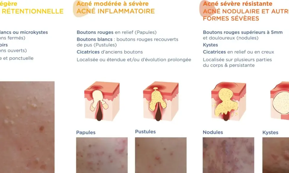 Schéma illustrant les différents types d'acné, des points blancs aux kystes, montrant l'évolution d'un bouton de puberté.